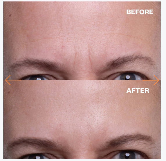 Ageless Beauty Silicone Wrinkle Patches